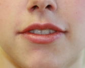 Feel Beautiful - Juvederm into lips - After Photo